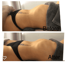 Lymphatic+Drainage