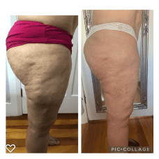 cellulite