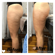 cellulite.png2