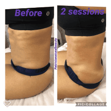 diastasis.png2