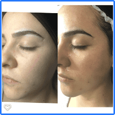 facial