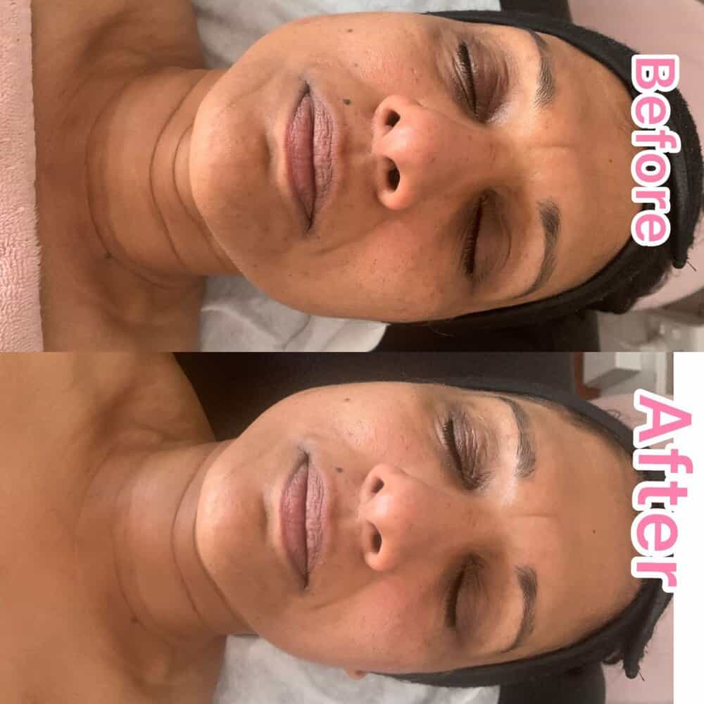 lymphatic+drainage+facial
