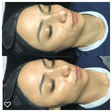 microdermabrasion.png02